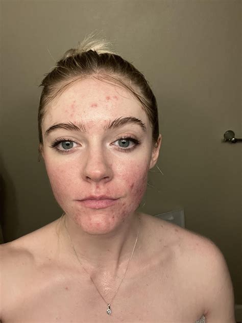 How did acne scars affect your life? I'll go first. : r/AcneScars