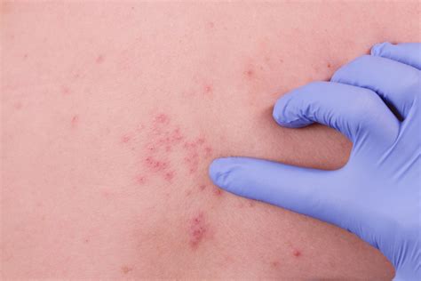 conditions mistaken  shingles herpes zoster
