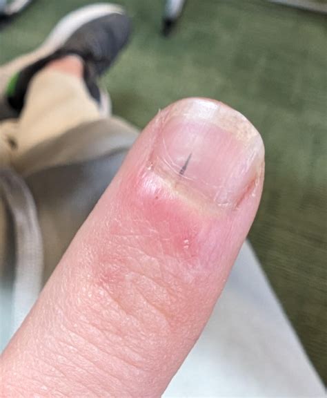 Subungual? : r/Melanoma