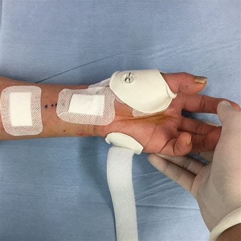 Following surgery, the operated thumb was protected by a small ...