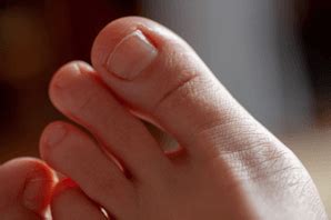 Expert Treatment for Painful Longer Second Toe Conditions | Foot and ...