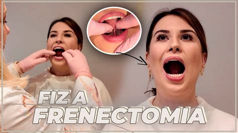 Frenectomia Antes E Depois - POR QUE FIZ FRENECTOMIA? + ANTES E DEPOIS, RESULTADOS E PÓS OPERATÓRIO ...
