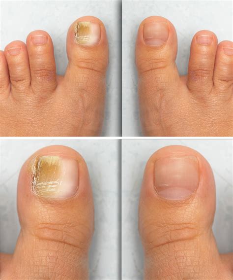 Cutera Archives - Torrey Pines Dermatology & Laser Center