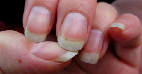 Nail Fungus Pictures Early Stage - NAIL HUK