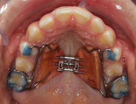 palatal expanders  adults  comprehensive guide  benefits