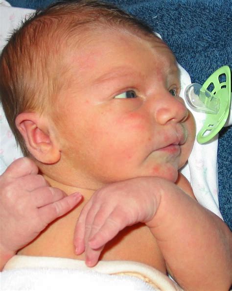 Erythema toxicum neonatorum causes, diagnosis & erythema toxicum treatment