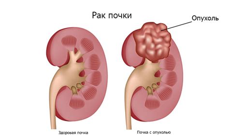 Рак почки: симптомы и признаки, диагностика | Mosmedic.com