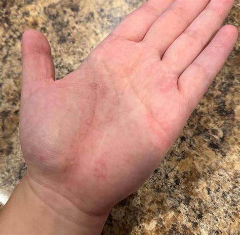 Possible gel polish allergy? : r/GelNails