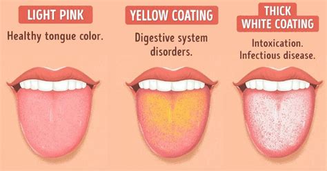 Healthy Tongue Pictures Vs Unhealthy