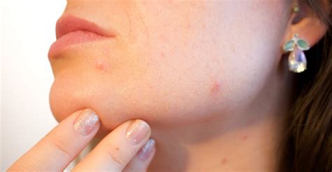 Acne Treatment. Essential Things To Know I Coolherbals
