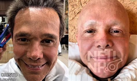 Netinho Antes E Depois - Cantor Netinho celebra crescimento do cabelo após tratamento contra o ...