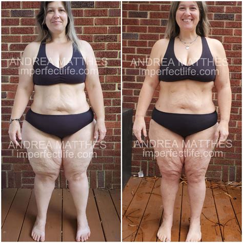 lipedema surgery before and after 3 - I'mperfect Life
