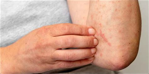 Understanding Hand Foot Mouth Disease: Symptoms & Prevention
