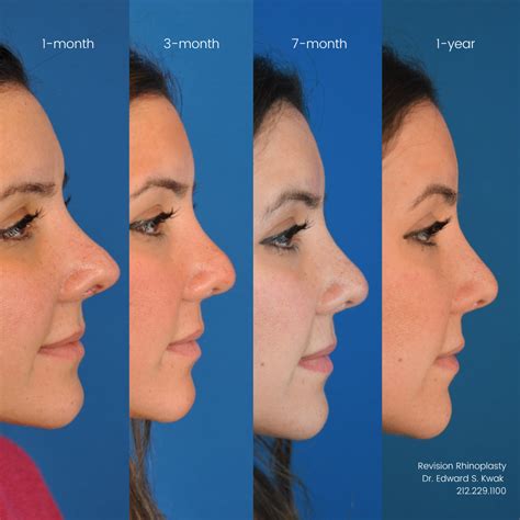 rhinoplasty nose job artofit