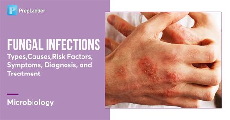 Fungal Infections: Types, Causes, Symptoms, Diagnosis & Prognosis 