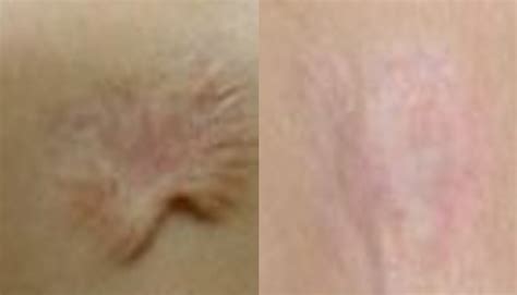 Laser Keloid Removal Archives | Fairview Laser Clinic Inc.