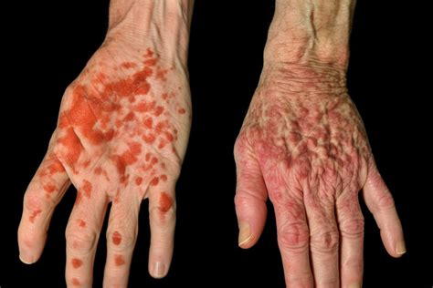 Psoriasis Vs Eczema: The Key Differences You Need To Know by Leo Hayes