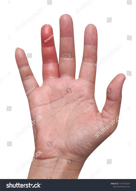 Asian Woman Right Palm Red Swelling Stock Photo 1517679224 | Shutterstock