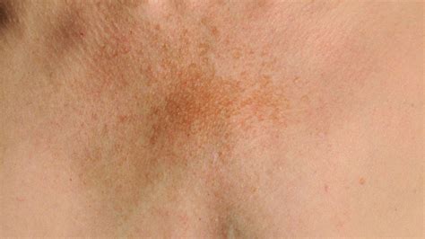 Melasma No Pescoço Na Gravidez - Tudo o que você precisa saber sobre melasma no pescoço - Dra. Juliana Toma
