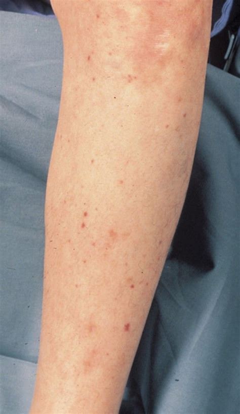Image:Petechiae Secondary to Meningococcemia (Leg)-MSD Manual