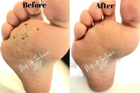 Salicylic Acid Plantar Wart Removal Stages | Bruin Blog