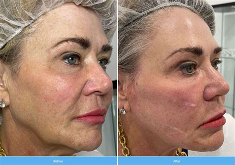 thread lift beauty medica