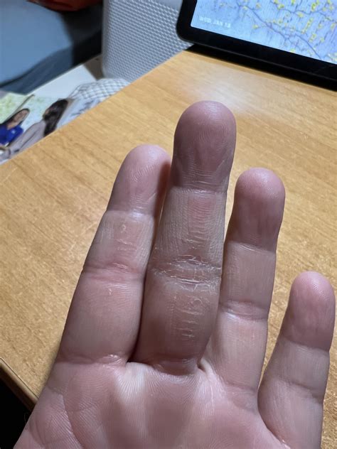 Nail clippers on callus : r/peeling