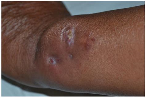 Erythema Nodosum following Nocardia Infection: A Case Report