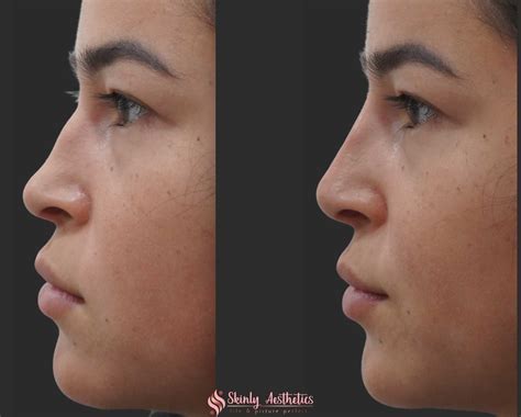 Nose Fillers Before And After