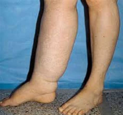 lymphatic yoga  lymphedema edely wallace
