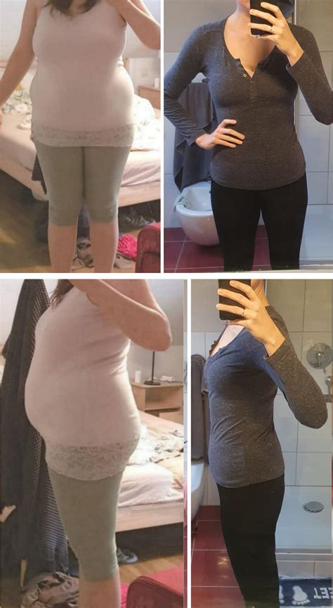 Before And After Getting Pcos