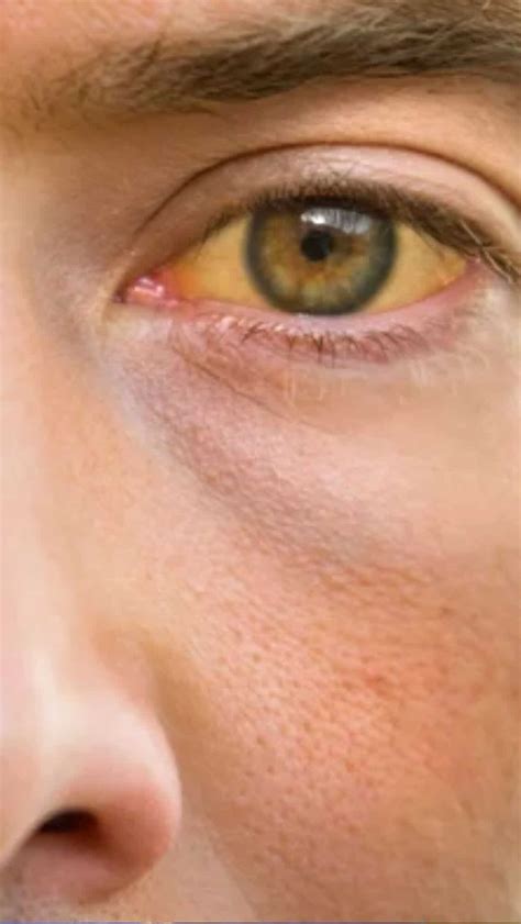liver disease  superfoods  fight jaundice
