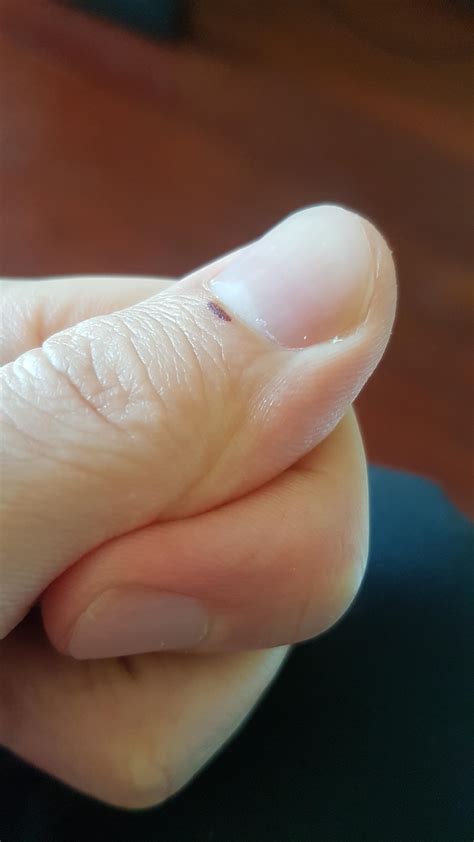 line under fingernail 4