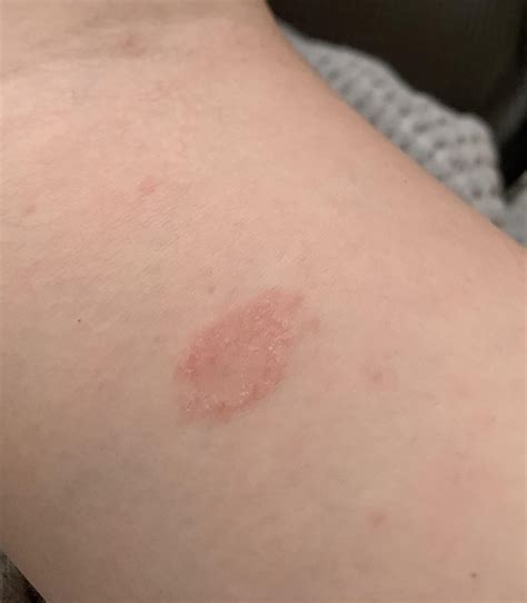 List 104+ Pictures What Does Ringworm Look Like On A Person Sharp