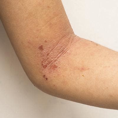 Update on Pediatric Atopic Dermatitis | MDedge Dermatology