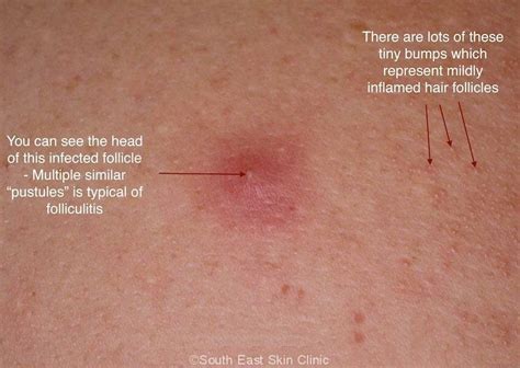 Folliculitis Anatomy