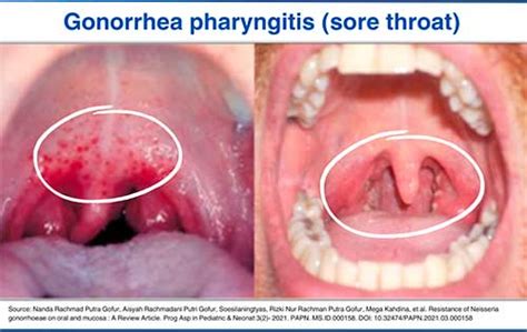 std white spots  tonsils infoupdateorg