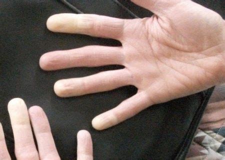 Ночью немеет правая рука: Причины онемения во время сна