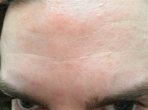[Skin Concerns] Itchy, inflamed bumps and patches on forehead
