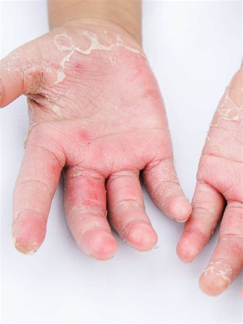 Skin Peeling, Is It Normal Or Not? - Serenitree Indonesia