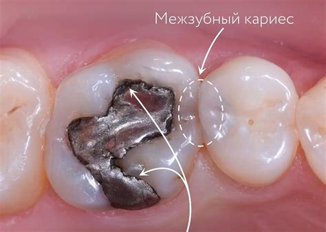 Случай из практики: пломба-терминатор | Стоматология Belgravia Dental ...