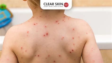 Comprehensive Chicken Pox Overview | Clear Skin Clinic Pune