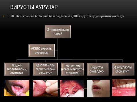 Балалардың ауыз қуысының шырышты қабатының вирусты аурулары ...
