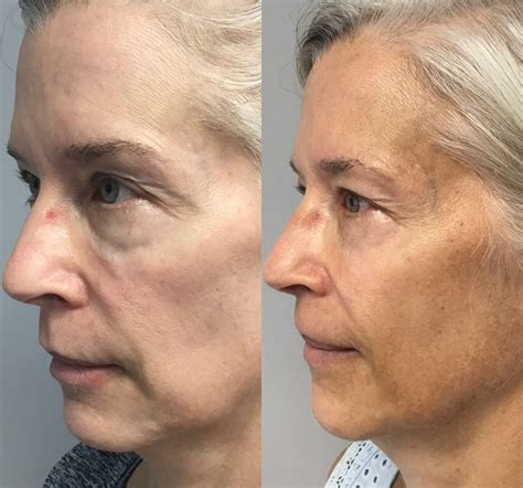 sculptra injections  cheek wrinkles hush la medspa