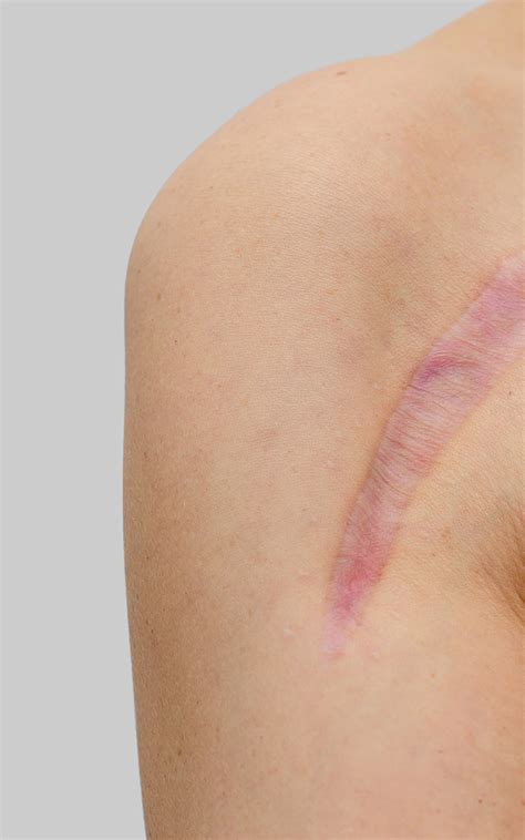 personal injury scarring disfigurations van eman law llc