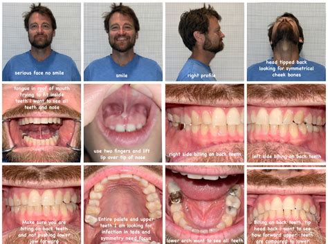 Maxillary Skeletal Expansion (MSE) | Dentist Arlington, VA
