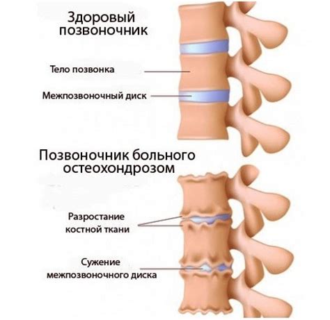 Остеохондроз хребта - Санаторий им Пирогова Куяльник