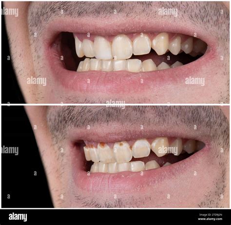 Emax crowns and veneers Stock Photo - Alamy