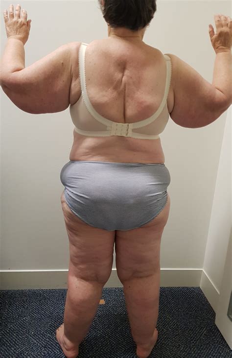 What Does Lipedema Fat Look Like In Vietnam Vets - Infoupdate.org