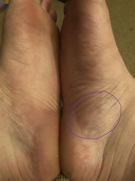 Tender puffy area. Hurts when walking and at rest. Next to other foot